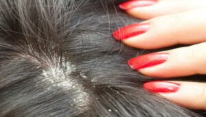 Home remedies for hair fall