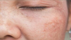 Reason for pigmentation on face